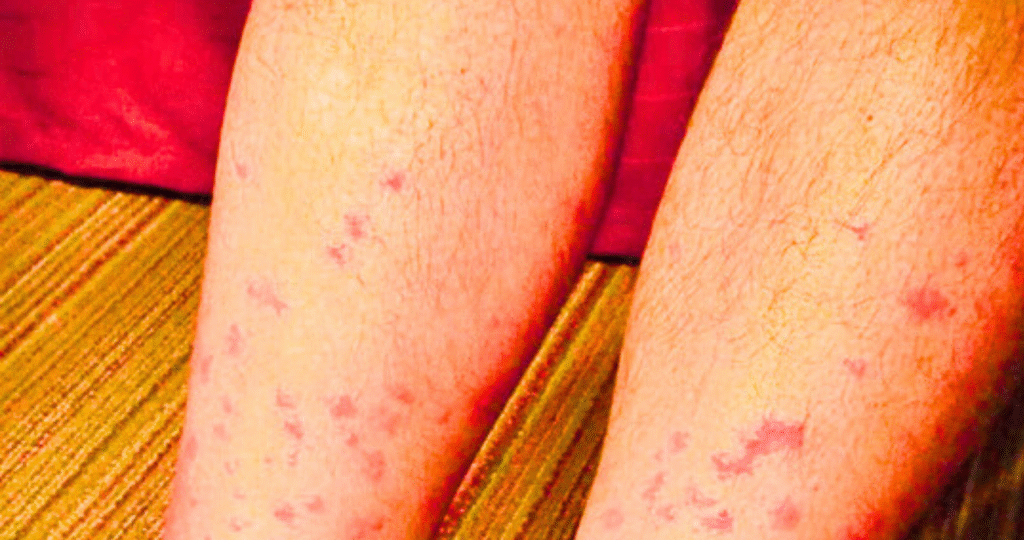 Can Chiggers Live in Bedding