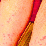 Can Chiggers Live in Bedding